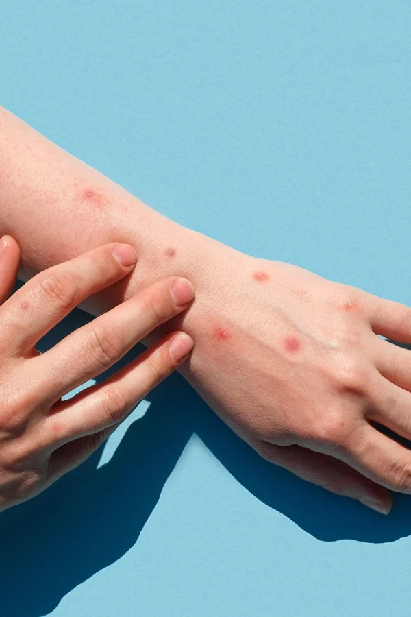 Two forearms against a pale blue background, one resting on top of the other, showing red spots indicative of a skin condition or reaction. The visible hand is gently touching the affected area, which has multiple raised red lesions. This image emphasizes the importance of being attentive to changes in skin health and encourages seeking medical advice for diagnosis and treatment.